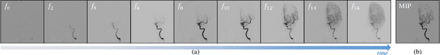 Figure 1 for DSCA: A Digital Subtraction Angiography Sequence Dataset and Spatio-Temporal Model for Cerebral Artery Segmentation