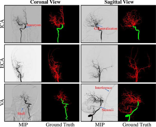 Figure 3 for DSCA: A Digital Subtraction Angiography Sequence Dataset and Spatio-Temporal Model for Cerebral Artery Segmentation