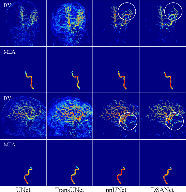 Figure 2 for DSCA: A Digital Subtraction Angiography Sequence Dataset and Spatio-Temporal Model for Cerebral Artery Segmentation