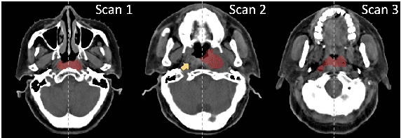 Figure 1 for Leveraging Semantic Asymmetry for Precise Gross Tumor Volume Segmentation of Nasopharyngeal Carcinoma in Planning CT