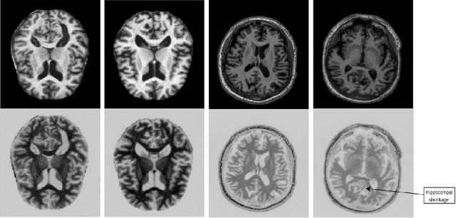 Figure 3 for AD-Lite Net: A Lightweight and Concatenated CNN Model for Alzheimer's Detection from MRI Images