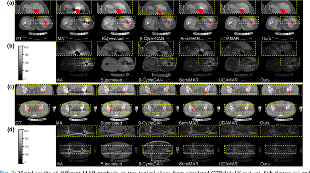 Figure 4 for Radiologist-in-the-Loop Self-Training for Generalizable CT Metal Artifact Reduction