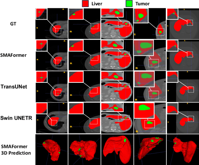 Figure 3 for SMAFormer: Synergistic Multi-Attention Transformer for Medical Image Segmentation