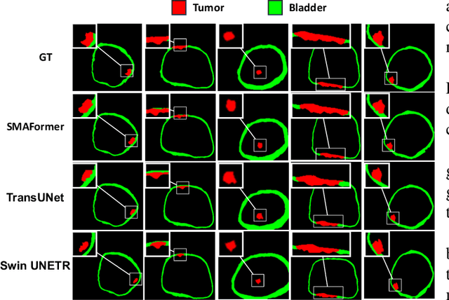 Figure 4 for SMAFormer: Synergistic Multi-Attention Transformer for Medical Image Segmentation