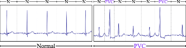 Figure 3 for Evaluating Feature Attribution Methods for Electrocardiogram