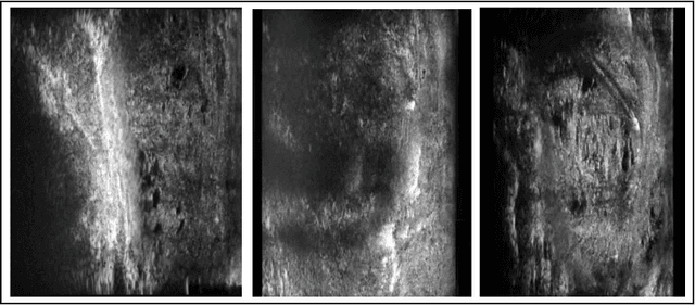 Figure 3 for Prostate Capsule Segmentation from Micro-Ultrasound Images using Adaptive Focal Loss