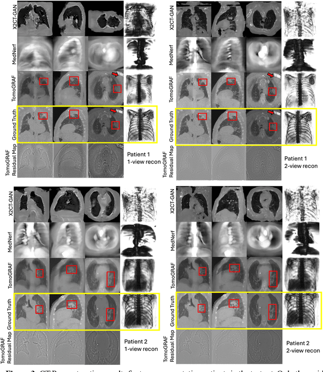 Figure 4 for TomoGRAF: A Robust and Generalizable Reconstruction Network for Single-View Computed Tomography