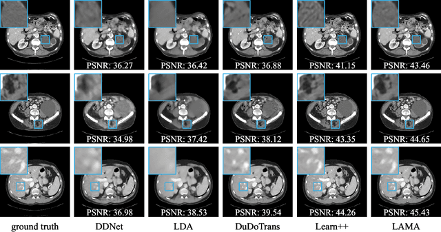 Figure 4 for LAMA: Stable Dual-Domain Deep Reconstruction For Sparse-View CT