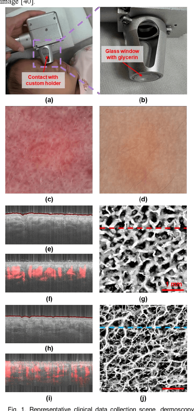 Figure 1 for Fine-grained Classification of Port Wine Stains Using Optical Coherence Tomography Angiography