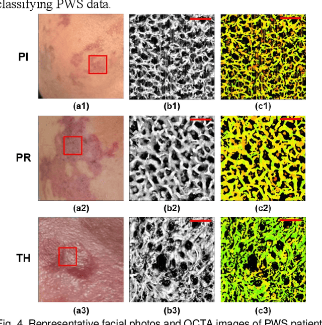 Figure 4 for Fine-grained Classification of Port Wine Stains Using Optical Coherence Tomography Angiography