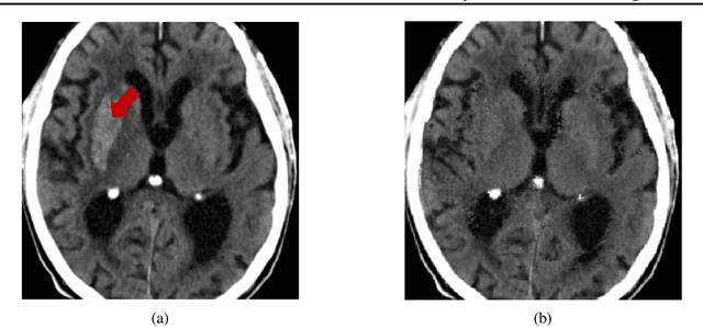 Figure 4 for Diffusion Models for Counterfactual Generation and Anomaly Detection in Brain Images