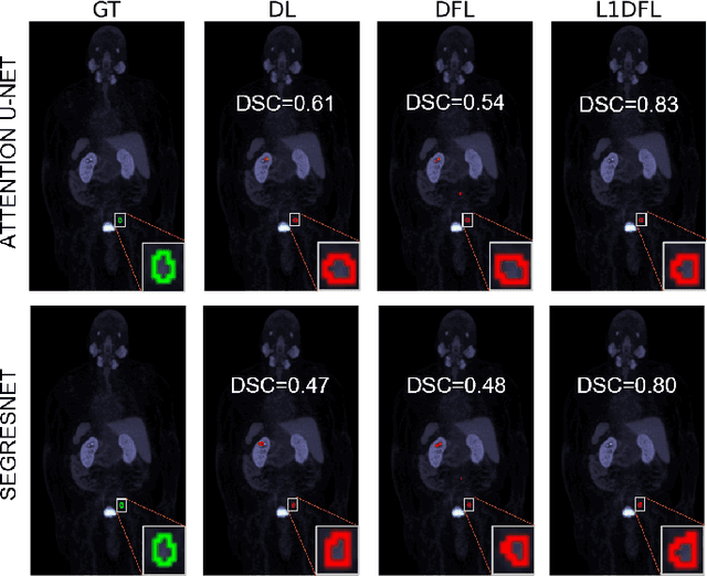 Figure 4 for Adaptive Voxel-Weighted Loss Using L1 Norms in Deep Neural Networks for Detection and Segmentation of Prostate Cancer Lesions in PET/CT Images