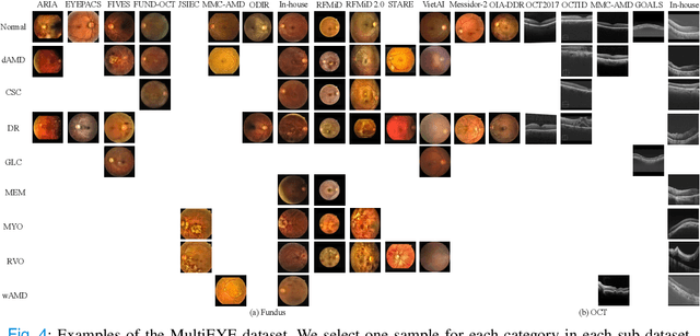 Figure 4 for MultiEYE: Dataset and Benchmark for OCT-Enhanced Retinal Disease Recognition from Fundus Images