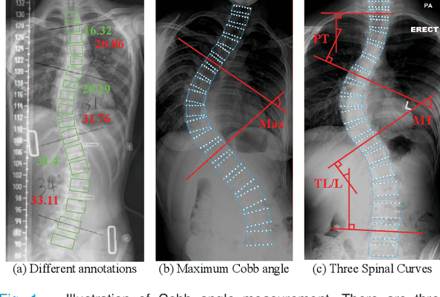 Figure 1 for SG-LRA: Self-Generating Automatic Scoliosis Cobb Angle Measurement with Low-Rank Approximation