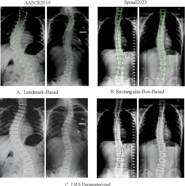 Figure 3 for SG-LRA: Self-Generating Automatic Scoliosis Cobb Angle Measurement with Low-Rank Approximation