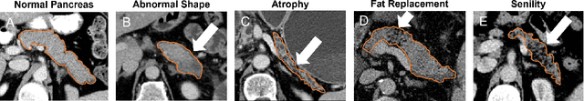 Figure 2 for Non-Redundant Combination of Hand-Crafted and Deep Learning Radiomics: Application to the Early Detection of Pancreatic Cancer