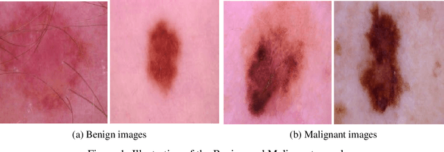 Figure 2 for Skin Cancer Images Classification using Transfer Learning Techniques