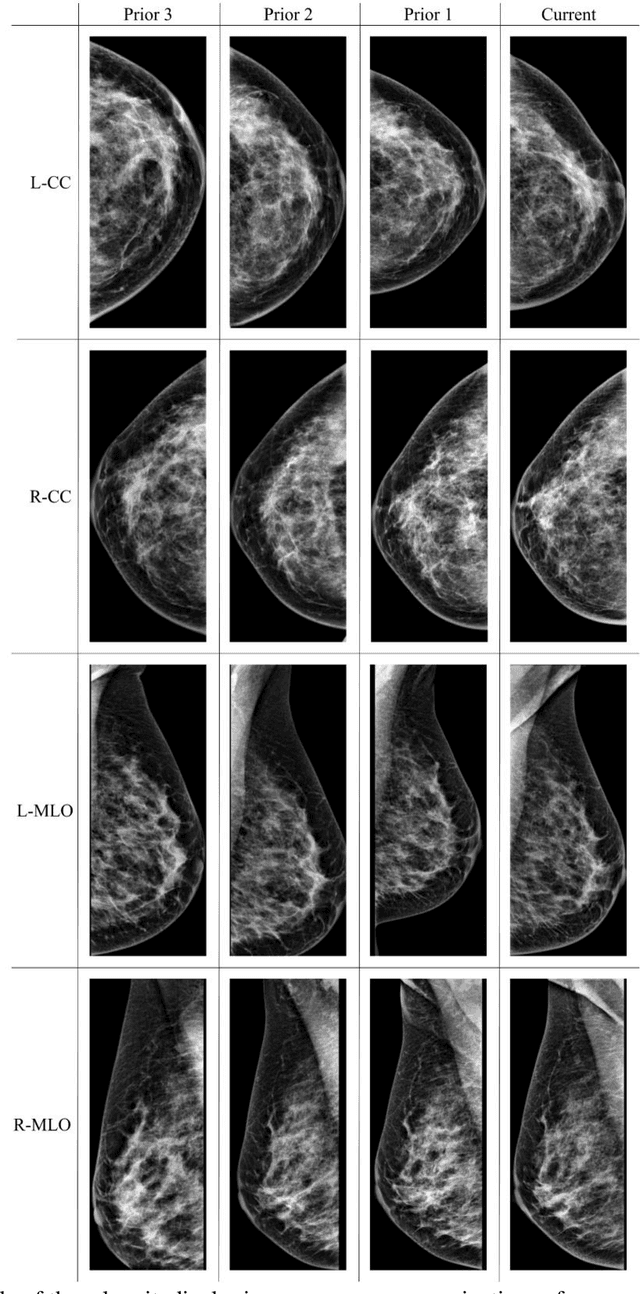 Figure 2 for RADIFUSION: A multi-radiomics deep learning based breast cancer risk prediction model using sequential mammographic images with image attention and bilateral asymmetry refinement