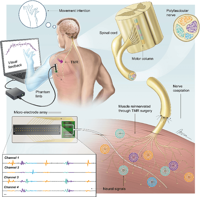 Figure 1 for Separation of Neural Drives to Muscles from Transferred Polyfunctional Nerves using Implanted Micro-electrode Arrays