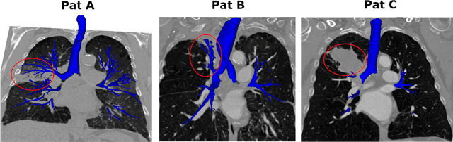 Figure 1 for AeroPath: An airway segmentation benchmark dataset with challenging pathology