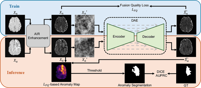 Figure 2 for Rethinking Medical Anomaly Detection in Brain MRI: An Image Quality Assessment Perspective