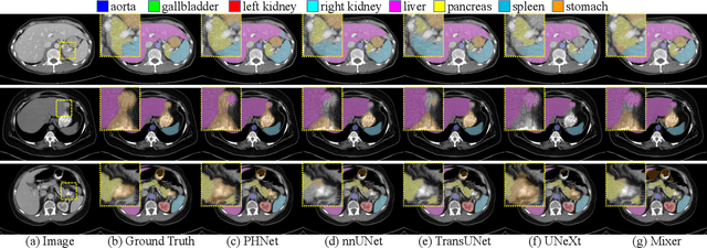 Figure 4 for A Permutable Hybrid Network for Volumetric Medical Image Segmentation