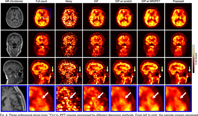 Figure 4 for Self-Supervised Pre-Training for Deep Image Prior-Based Robust PET Image Denoising