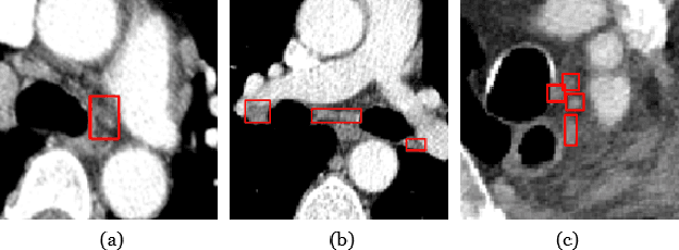 Figure 1 for SDF-Net: A Hybrid Detection Network for Mediastinal Lymph Node Detection on Contrast CT Images