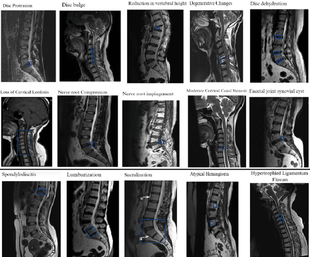 Figure 4 for AI-Driven MRI Spine Pathology Detection: A Comprehensive Deep Learning Approach for Automated Diagnosis in Diverse Clinical Settings