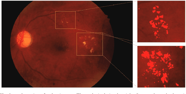 Figure 1 for A Global and Patch-wise Contrastive Loss for Accurate Automated Exudate Detection
