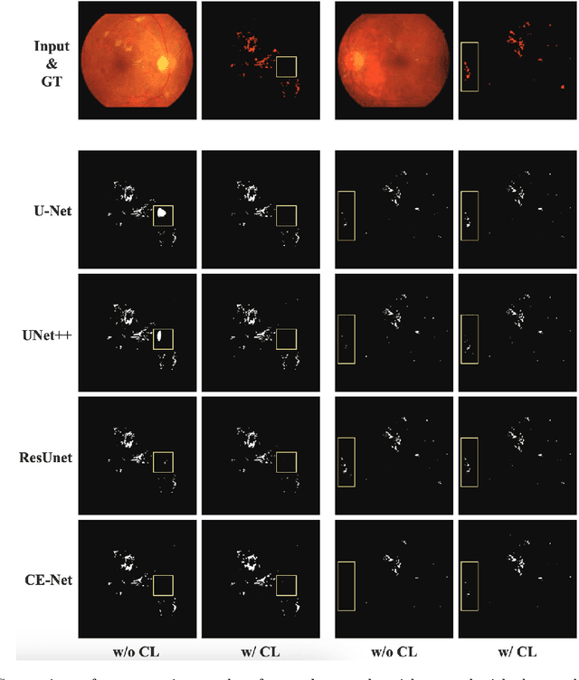 Figure 4 for A Global and Patch-wise Contrastive Loss for Accurate Automated Exudate Detection