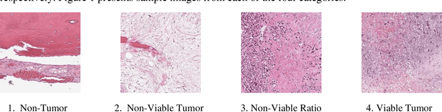 Figure 1 for Advanced Hybrid Deep Learning Model for Enhanced Classification of Osteosarcoma Histopathology Images