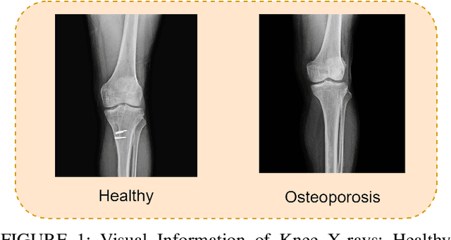 Figure 1 for Computer-Aided Osteoporosis Diagnosis Using Transfer Learning with Enhanced Features from Stacked Deep Learning Modules