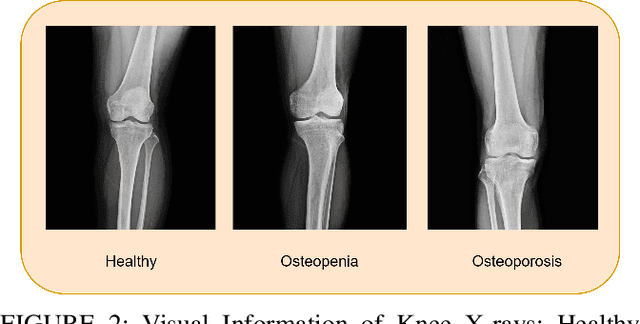 Figure 4 for Computer-Aided Osteoporosis Diagnosis Using Transfer Learning with Enhanced Features from Stacked Deep Learning Modules