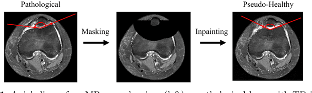 Figure 1 for Generating 3D Pseudo-Healthy Knee MR Images to Support Trochleoplasty Planning