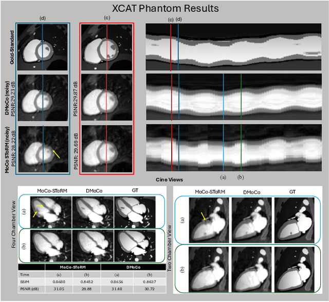 Figure 4 for Motion-compensated cardiac MRI using low-rank diffeomorphic flow (DMoCo)