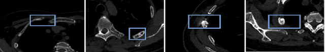 Figure 1 for Fine-Grained Rib Fracture Diagnosis with Hyperbolic Embeddings: A Detailed Annotation Framework and Multi-Label Classification Model