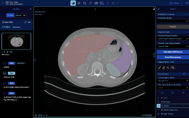 Figure 1 for QuickDraw: Fast Visualization, Analysis and Active Learning for Medical Image Segmentation
