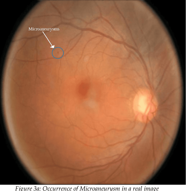 Figure 4 for Enhancing Early Diabetic Retinopathy Detection through Synthetic DR1 Image Generation: A StyleGAN3 Approach