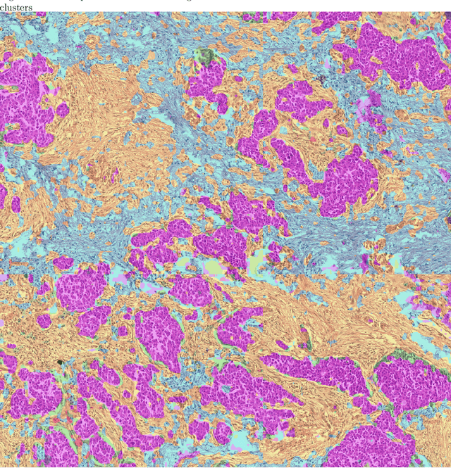 Figure 1 for Segmentation by Factorization: Unsupervised Semantic Segmentation for Pathology by Factorizing Foundation Model Features