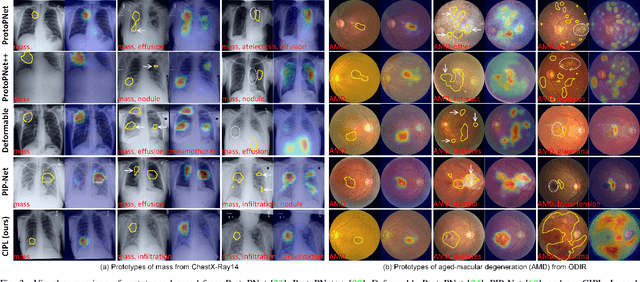 Figure 3 for Cross- and Intra-image Prototypical Learning for Multi-label Disease Diagnosis and Interpretation