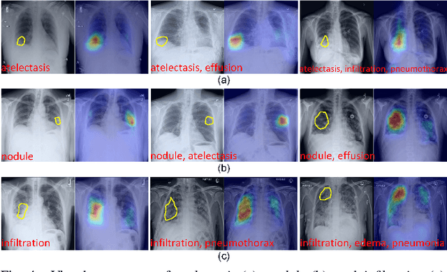 Figure 4 for Cross- and Intra-image Prototypical Learning for Multi-label Disease Diagnosis and Interpretation