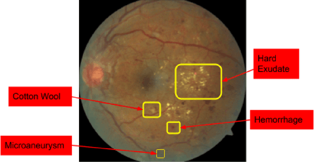 Figure 1 for Convolutional Neural Network Model for Diabetic Retinopathy Feature Extraction and Classification