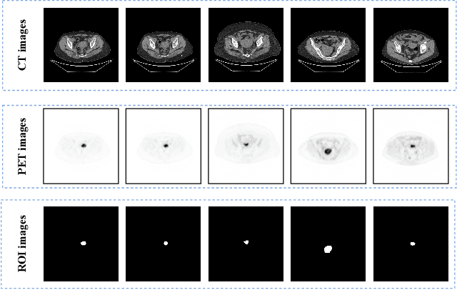 Figure 2 for ECPC-IDS:A benchmark endometrail cancer PET/CT image dataset for evaluation of semantic segmentation and detection of hypermetabolic regions