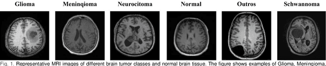 Figure 1 for Advancing Efficient Brain Tumor Multi-Class Classification -- New Insights from the Vision Mamba Model in Transfer Learning