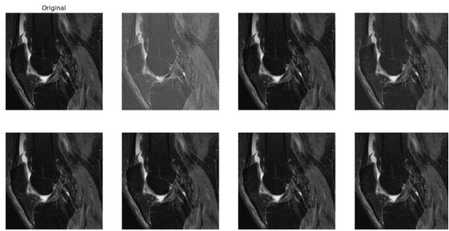 Figure 2 for Improving Generalization in MRI-Based Deep Learning Models for Total Knee Replacement Prediction