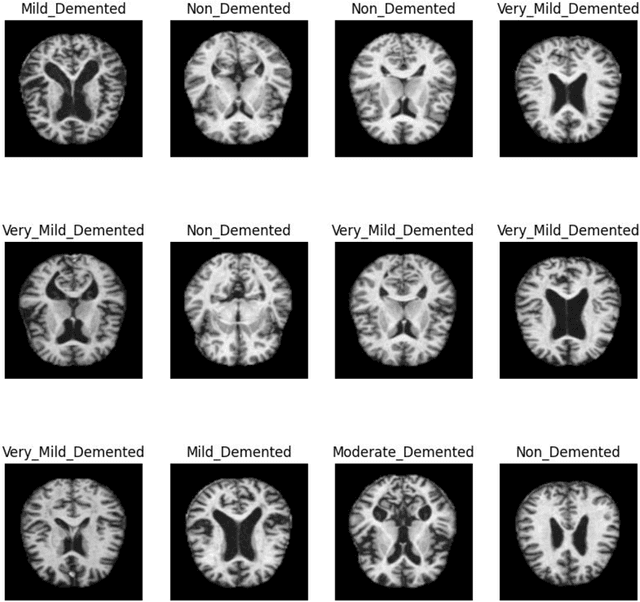 Figure 2 for A Hybrid Transfer Learning Assisted Decision Support System for Accurate Prediction of Alzheimer Disease