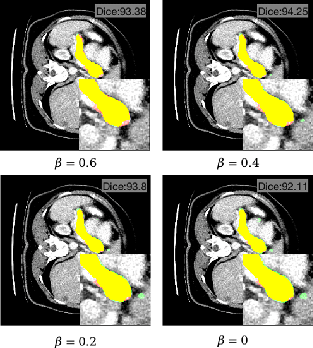 Figure 1 for Diffusion Probabilistic Multi-cue Level Set for Reducing Edge Uncertainty in Pancreas Segmentation