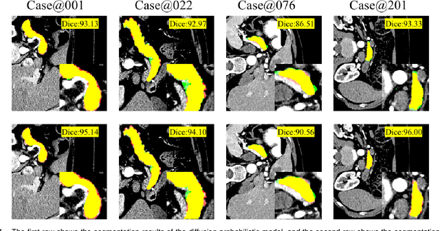 Figure 4 for Diffusion Probabilistic Multi-cue Level Set for Reducing Edge Uncertainty in Pancreas Segmentation