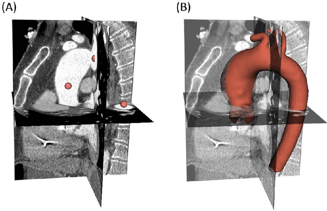 Figure 3 for Computer-aided shape features extraction and regression models for predicting the ascending aortic aneurysm growth rate